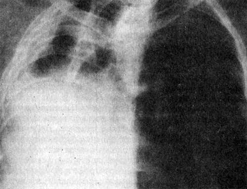 Суперэкспонированная рентгенограмма грудной клетки