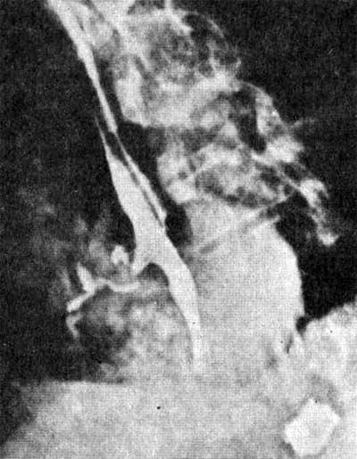 Рентгенограмма при эзофагобронхиальном свище