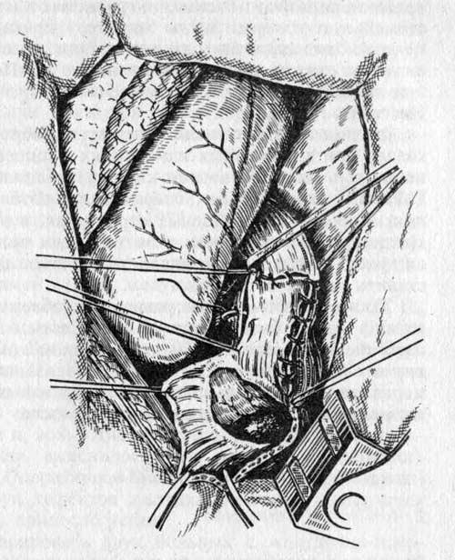 Диафрагмопластика по Петровскому