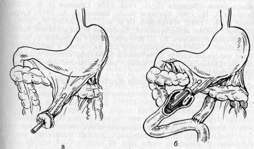 Наложение инвагинационного фистулоэнтероанастомоза