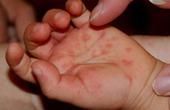 В Китае от энтеровируса скончались уже 34 ребенка