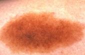 Меланодермия (Nevus spilus)