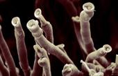 Подкожные грибковые инфекции (хромобластомикоз)