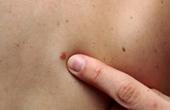 Главные причины немеланомных раков кожи