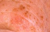 Предотвращение появления немеланозного рака кожи