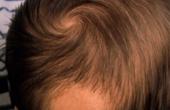 Формы выпадения волос