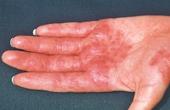 Насколько распространены заболевания кожи