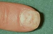 Кожные заболевания, сопровождающиеся изменениями со стороны ногтей