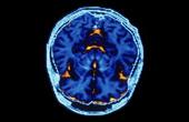 Рентгеновская компьютерная томография головного и спинного мозга