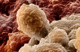 Клетки рака простаты