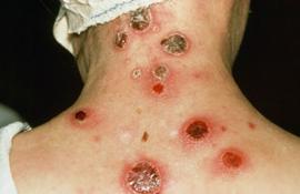 Сыпь и воспаления вторичного сифилиса на спине