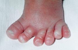 Нога с шестью пальцами у ребенка