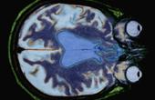 Американские ученые связали булимию с нарушением деятельности определенной зоны головного мозга