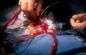 В России проведена первая в стране операция по установке «искусственного сердца»