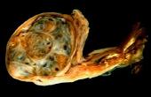 Обнаружены факторы наследственной предрасположенности к раку яичек