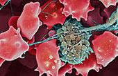 Стартовало крупнейшее исследование по изучению лечения и профилактики венозной тромбоэмболии