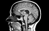 Измерение вещества головного мозга позволяет выявить прогрессирование рассеянного склероза