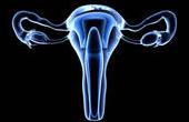 Найдена альтернатива гистерэктомии при стойкой миоме матки