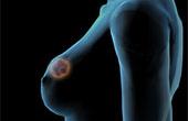 В Кировской области отмечается рост заболеваемости раком груди