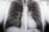 Минздравсоцразвития предлагает ввести в России принудительное лечение от туберкулеза