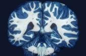 Обнаружено потенциальное лекарство от болезни головного мозга