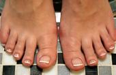 Ученые научились определять риск развития рака по обрезкам ногтей на ногах 