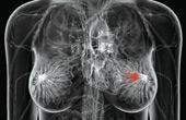 Интервенционные радиологи дают надежду на то, что смогут задерживать рост и распространение рака груди