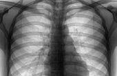 Рентген не в состоянии выявить туберкулез на ранней стадии