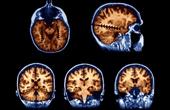 Выявлены генетические причины опухоли головного мозга