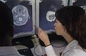 Стент в головном мозге может навредить перенесшим инсульт пациентам
