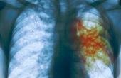 Курение может привести к миллионам смертей от туберкулеза