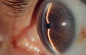 Операция по удалению катаракты безопаснее с использованием лазера