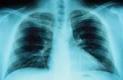 Рентгеновский досмотр не помогает в профилактике смертей от рака легких