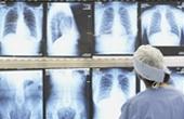 Ученые изучают геном некурящих пациентов с раком легких