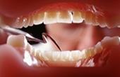 Кислотный рефлюкс на фоне изжоги может привести к повреждению зубов