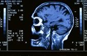 Распространенное заболевание может вызвать нарушение функций головного мозга