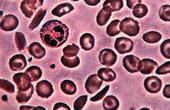 В лечении серповидно-клеточной анемии обнаружены пробелы