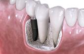 Исследователи увеличивают процент успешности зубной имплантации
