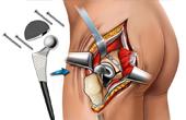 Тазобедренный сустав: проводим полную замену
