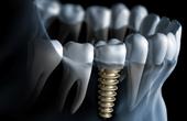Что нам нужно знать об имплантации зубов?