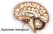 Хирургическое лечение аденомы гипофиза