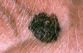 Можно ли предотвратить рак кожи?
