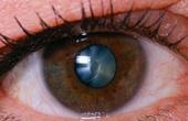 На что следует обратить внимание при катаракте