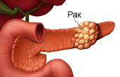 Что представляет собой опухоль поджелудочной железы?
