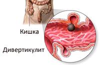 Каковы симптомы дивертикулита?