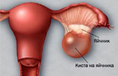 Причины кисты яичника