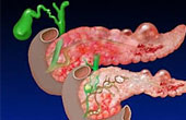 Панкреатит и холецистит