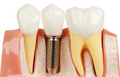 Имплантация зубов под зубные импланты