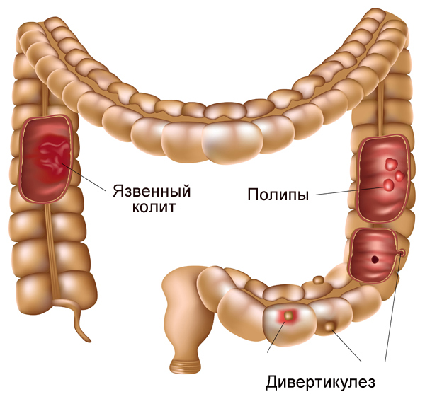 Какие симптомы имеет дивертикулит