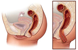 Пролапс прямой кишки